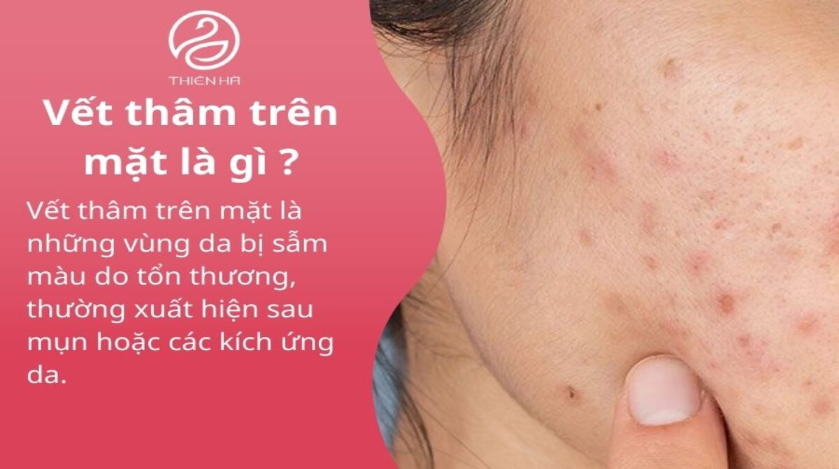 Vết thâm trên mặt: Nguyên nhân và cách làm mờ hiệu quả, an toàn