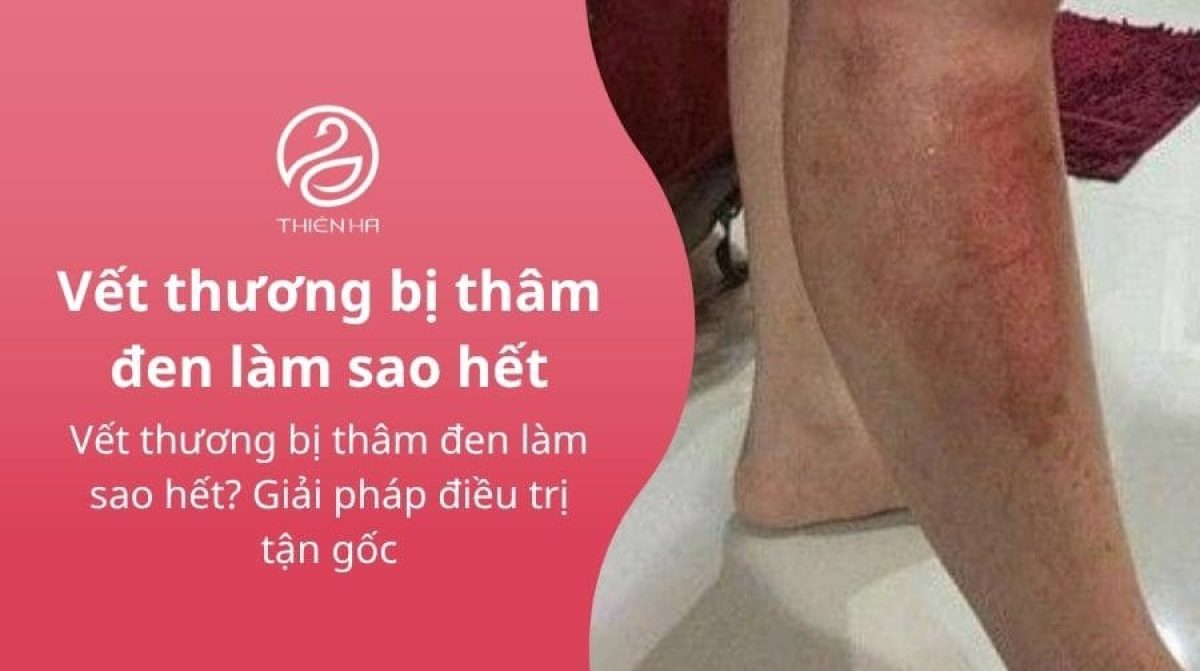 Vết thương bị thâm đen làm sao hết? Giải pháp điều trị tận gốc