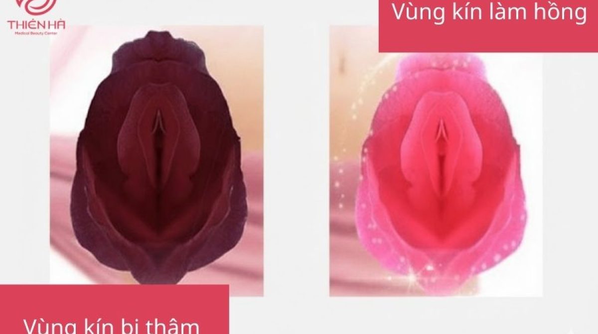 Nguyên nhân và cách cải thiện vùng kín thâm đen bẩm sinh an toàn