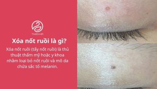 Xóa nốt ruồi an toàn: Phương pháp, chi phí và cách hạn chế sẹo
