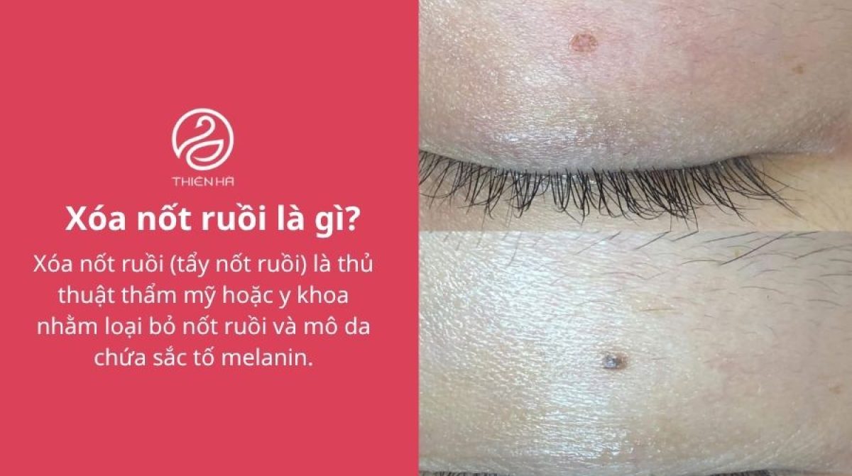 Xóa nốt ruồi an toàn: Phương pháp, chi phí và cách hạn chế sẹo