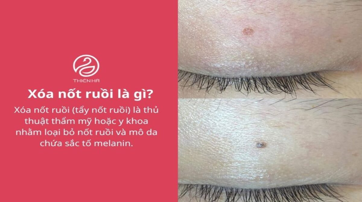 Xóa nốt ruồi an toàn: Phương pháp, chi phí và cách hạn chế sẹo