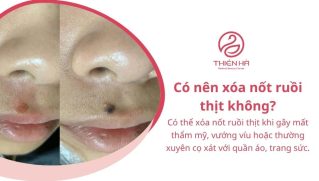 Xóa nốt ruồi thịt bằng cách nào? Phương pháp và chi phí thực hiện