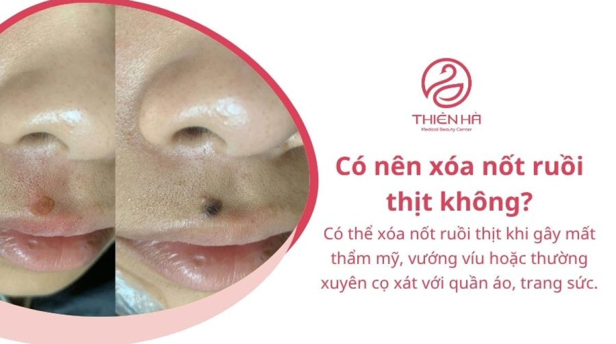 Xóa nốt ruồi thịt bằng cách nào? Phương pháp và chi phí thực hiện