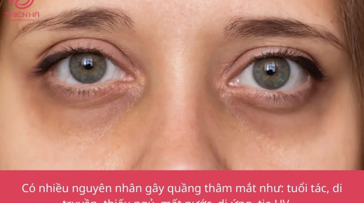 Xóa thâm quầng mắt giá bao nhiêu? Bảng giá mới nhất 
