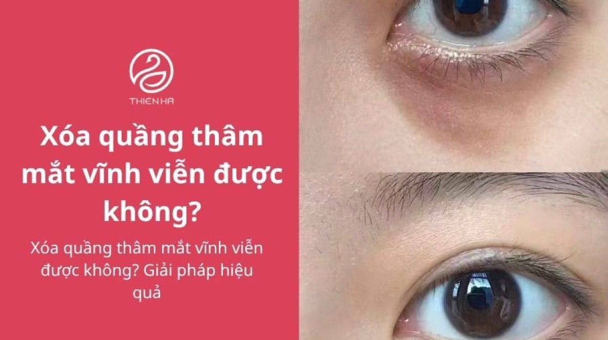 Xóa quầng thâm mắt vĩnh viễn được không? Giải pháp hiệu quả