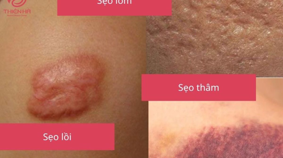 Xóa sẹo hiệu quả: Phương pháp, chi phí và lưu ý quan trọng | Viện thẩm mỹ Thiên Hà