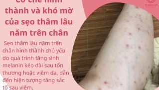 Cách xóa sẹo thâm ở chân lâu năm nhanh chóng được bác sĩ khuyên dùng