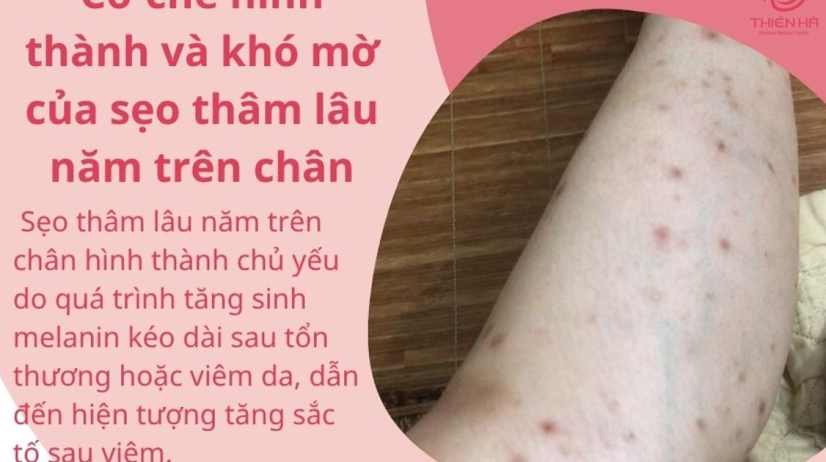 Cách xóa sẹo thâm ở chân lâu năm nhanh chóng được bác sĩ khuyên dùng
